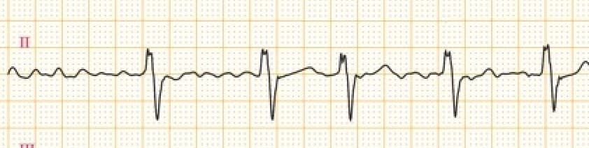 ECG: Interprétation en médecine générale